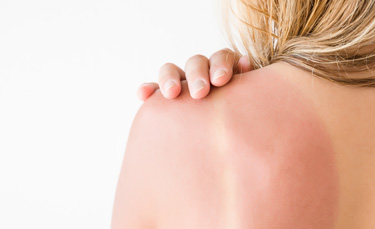 Prevent and relieve sunburn